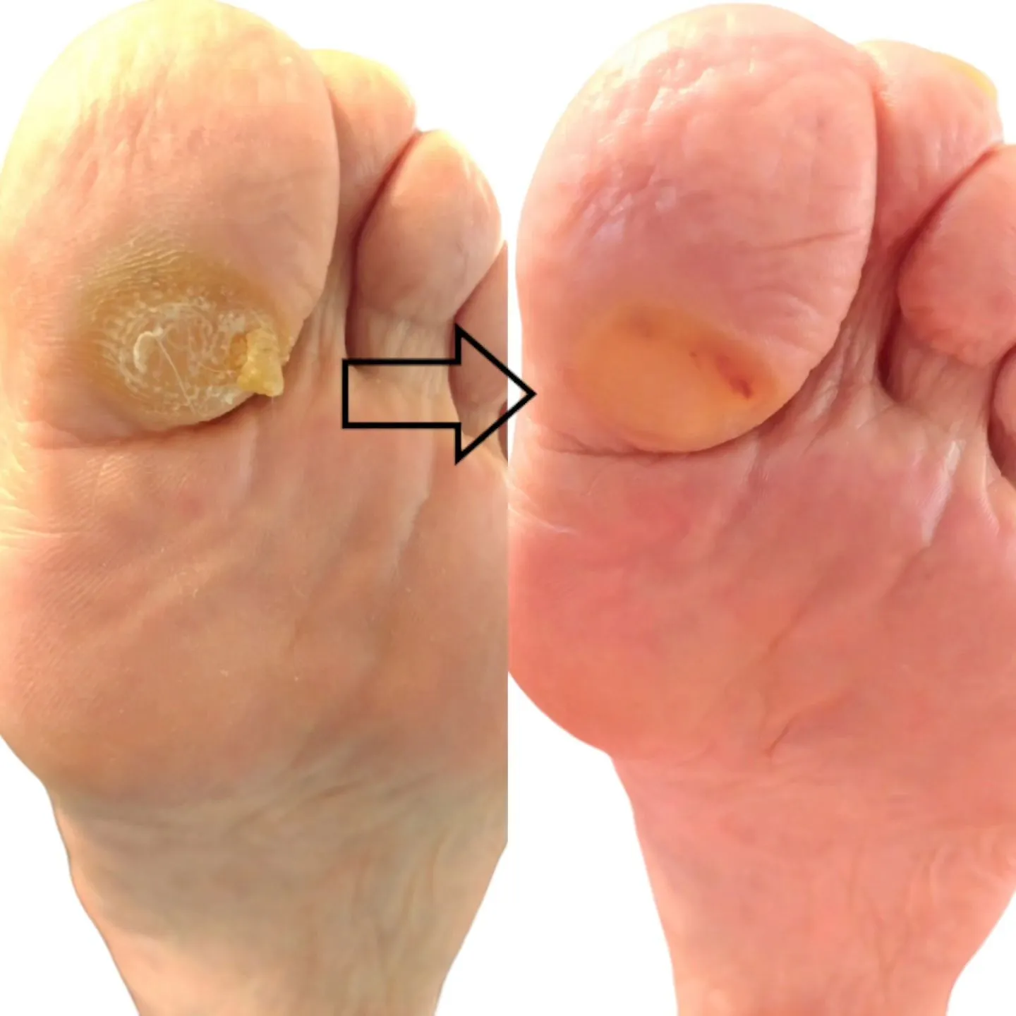 タコは足裏の様々な部位にできますが、浮き指の場合は、第１足趾...