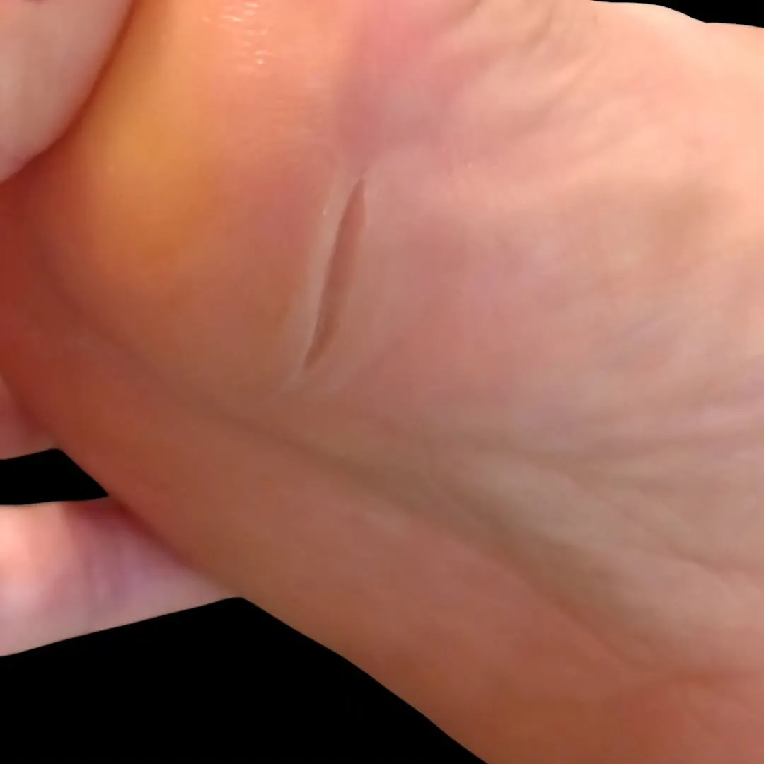 凹足の方は母指球に体重がかかることが多く、余分な角質で肥厚し...