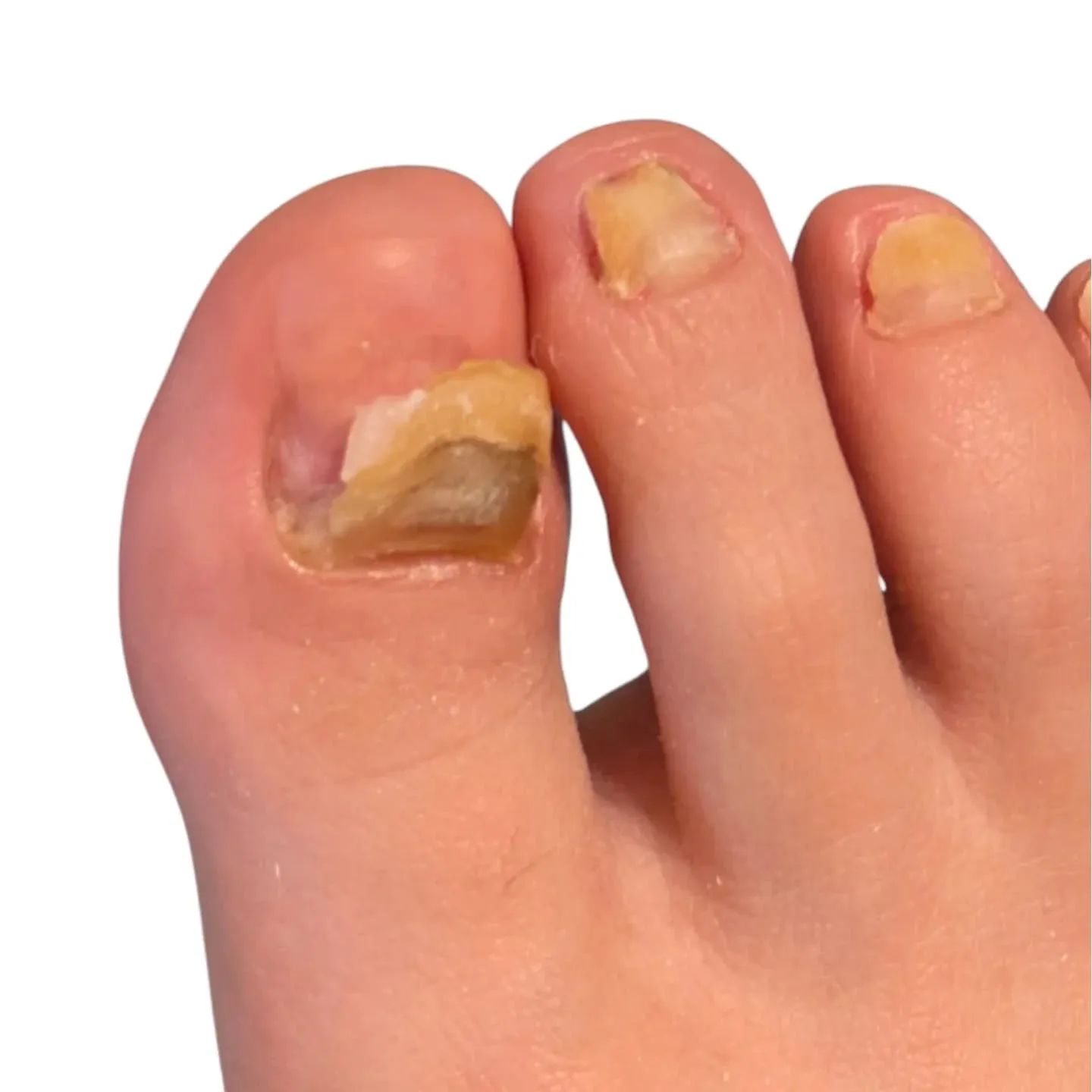 トラブル爪、アクリルでリペアして、サンダル👡でお出かけできる...