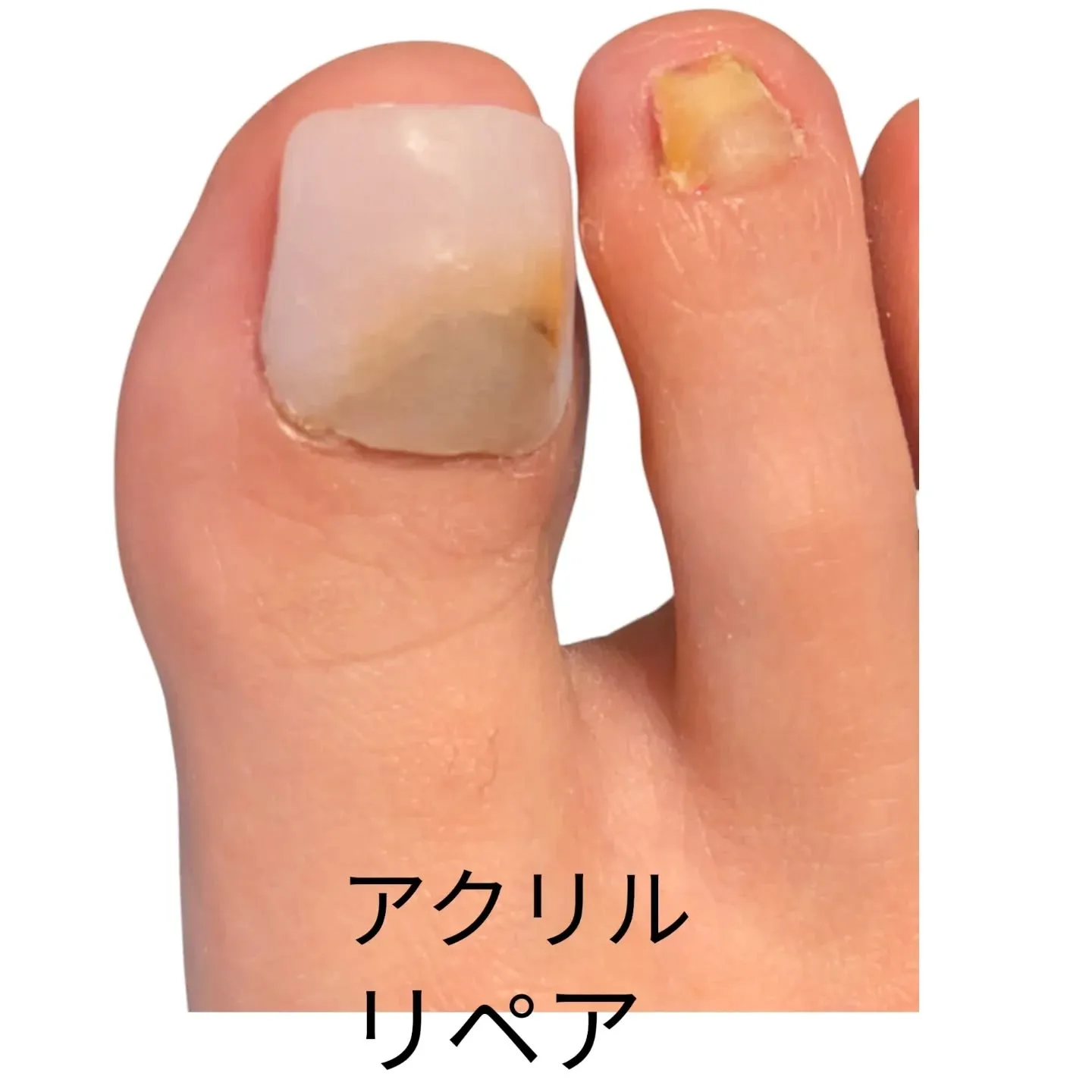 トラブル爪、アクリルでリペアして、サンダル👡でお出かけできる...