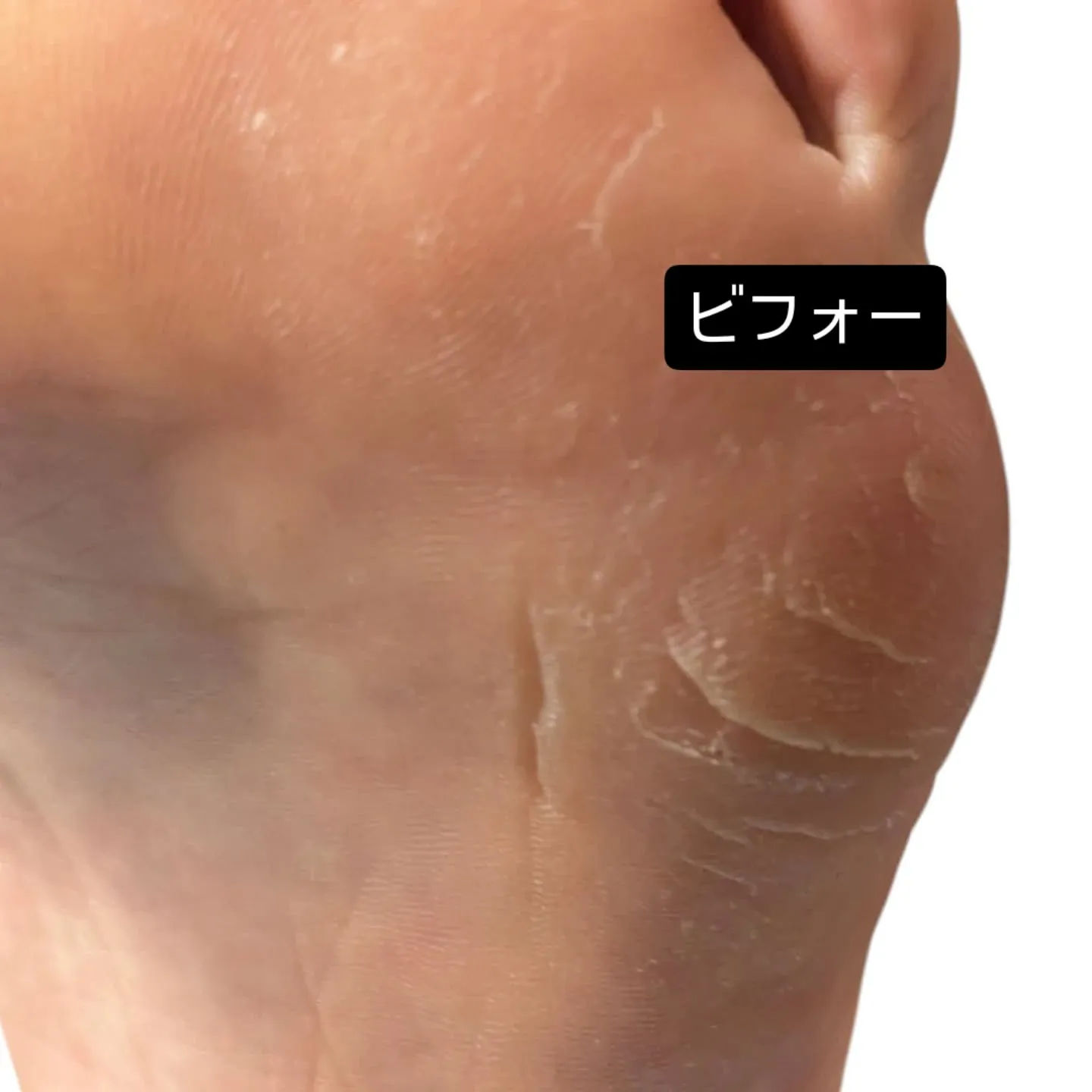 内反小趾による第5中足骨頭の突出が、靴との間で強い圧迫と摩擦...