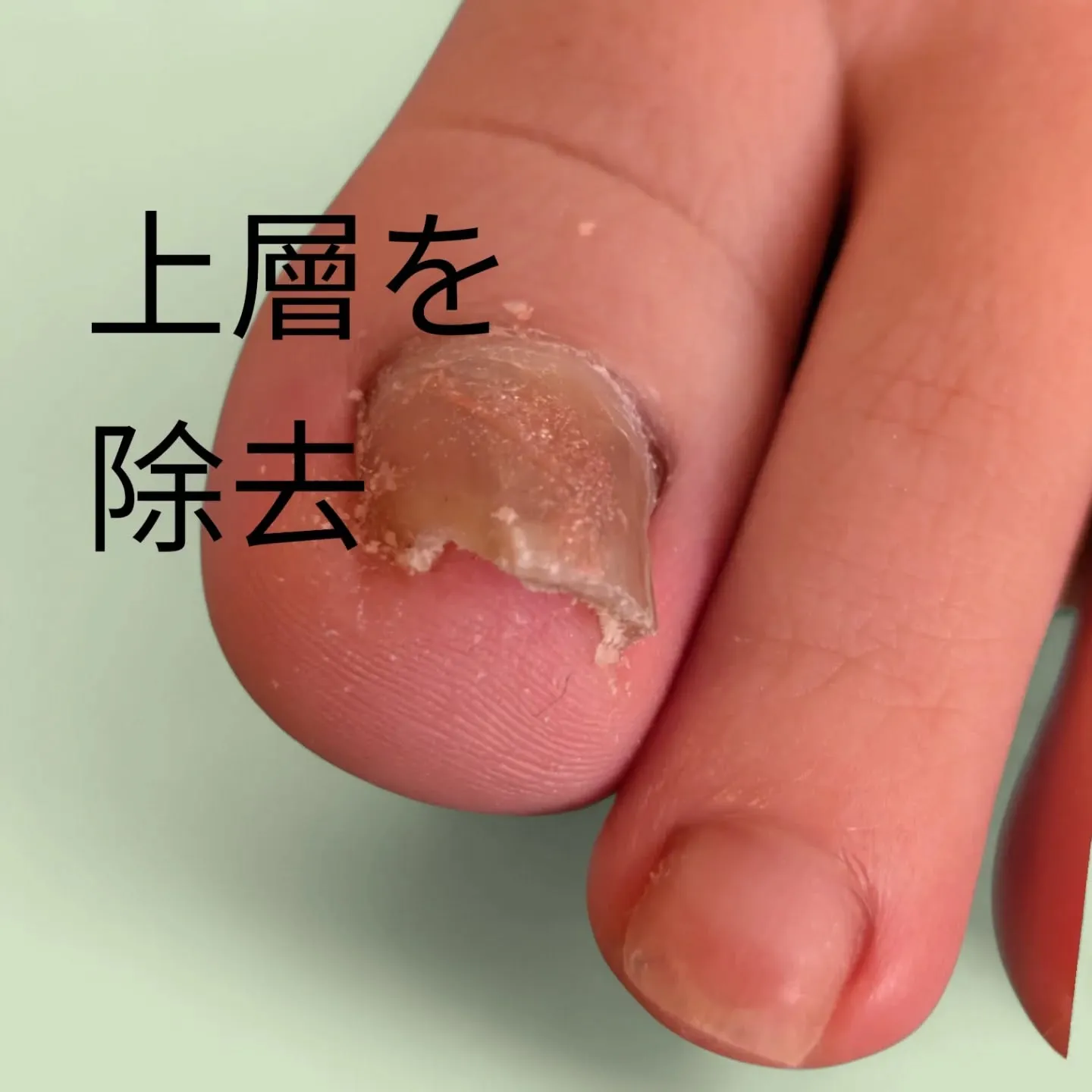 その亀裂、実は「隠れ巻き爪」のサインかも?❄️