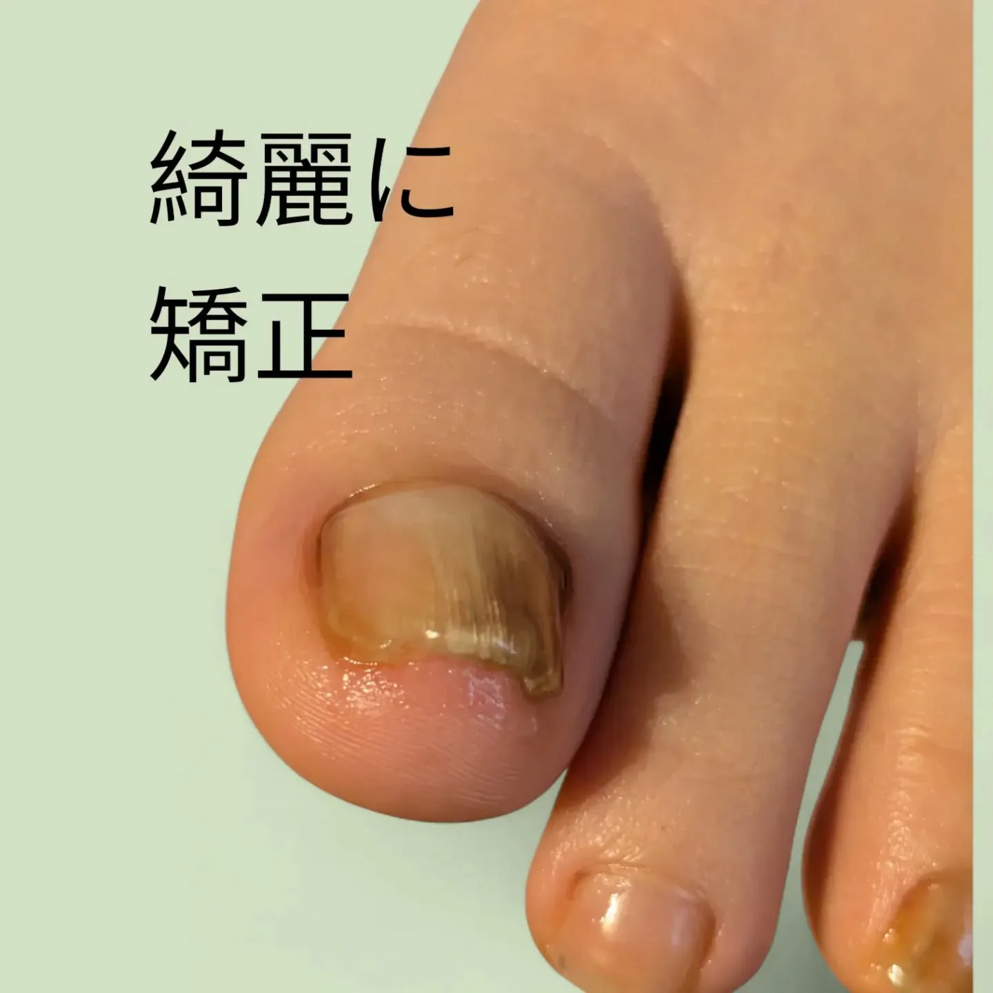 その亀裂、実は「隠れ巻き爪」のサインかも?❄️
