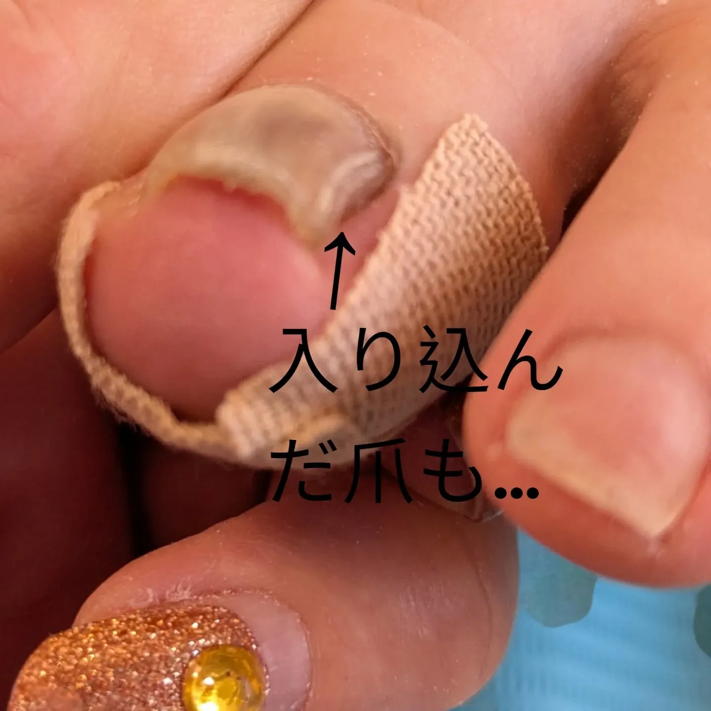その亀裂、実は「隠れ巻き爪」のサインかも?❄️
