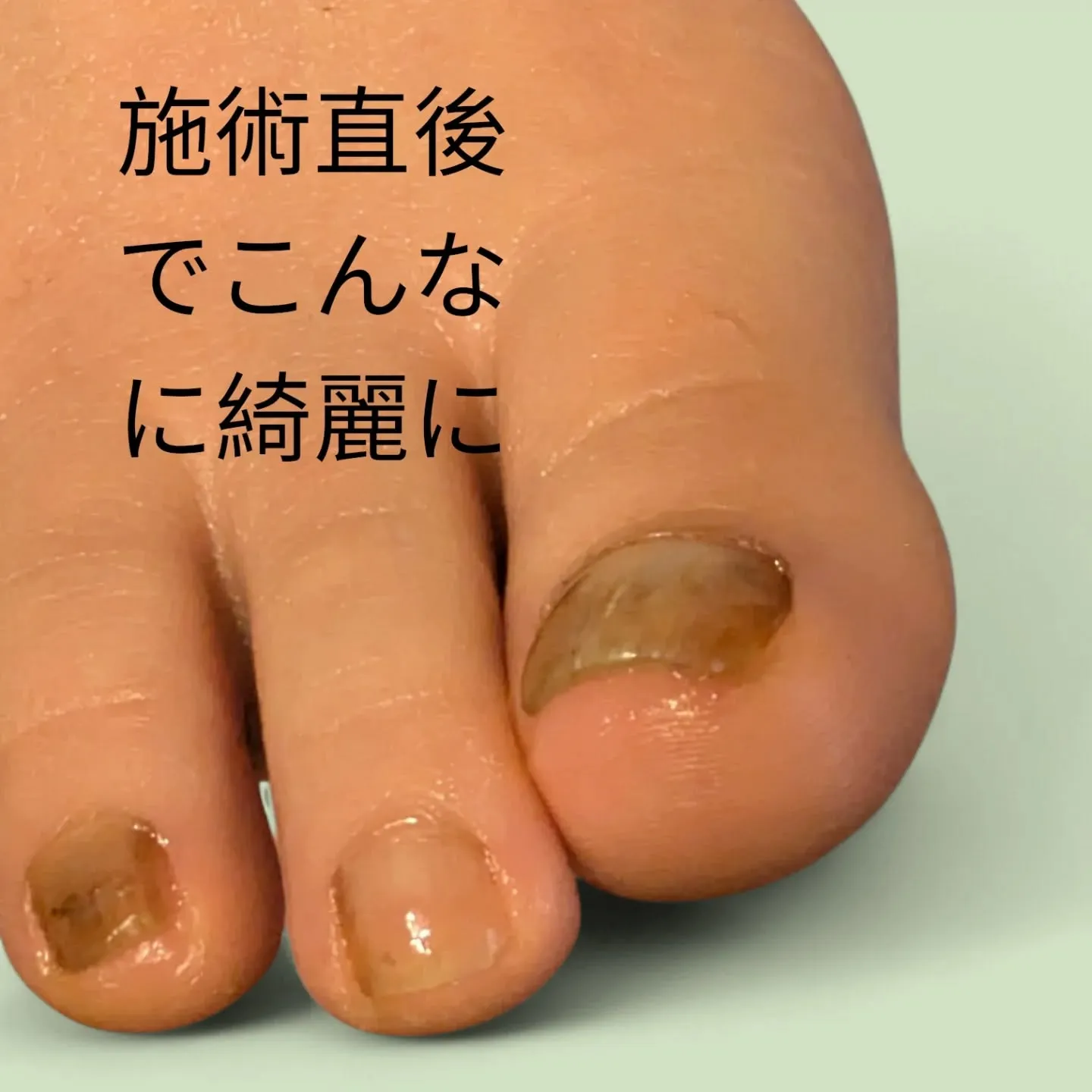 その亀裂、実は「隠れ巻き爪」のサインかも?❄️