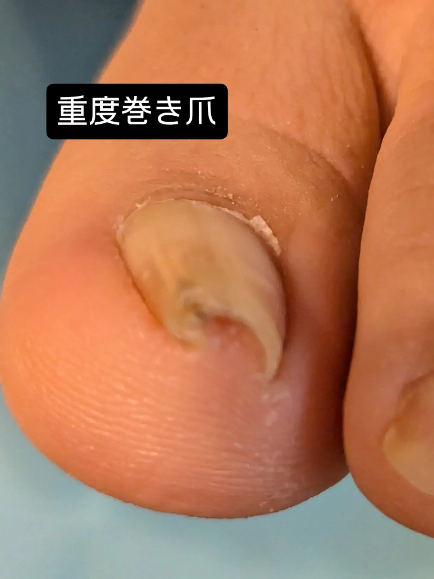 重度巻き爪ケア、3回目のお客様✨