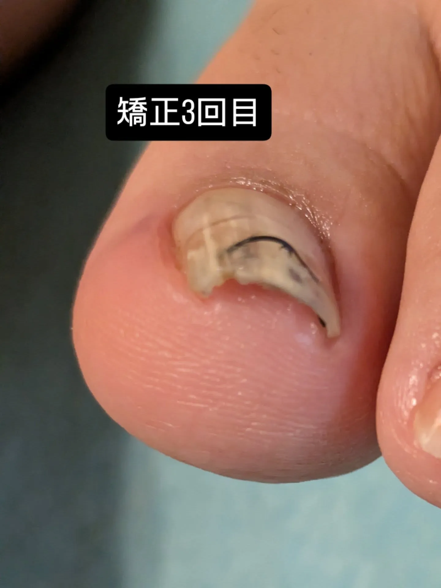 重度巻き爪ケア、3回目のお客様✨