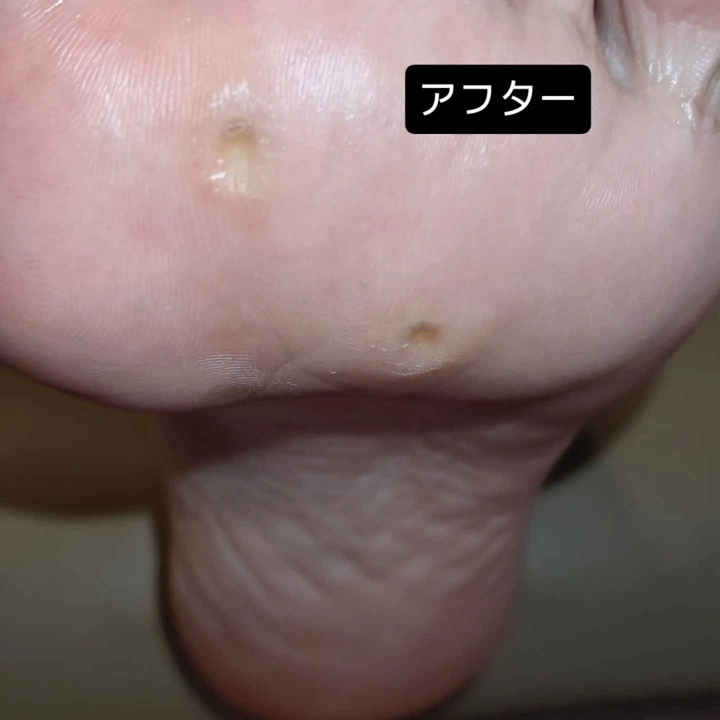 ハイアーチ（甲高）の足にはある特徴があります。