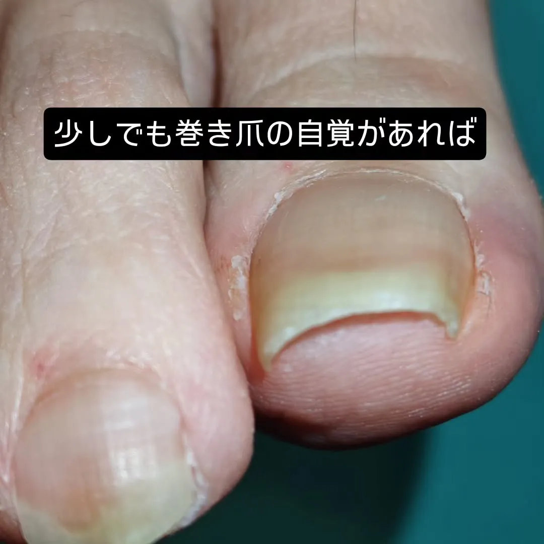 巻き爪が痛むとき、ついつい端っこを深く切ってしのいでいません...
