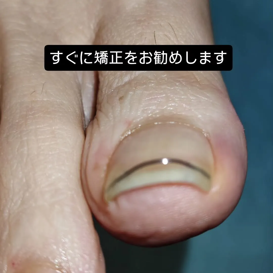 巻き爪が痛むとき、ついつい端っこを深く切ってしのいでいません...