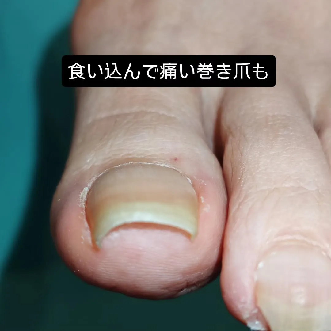 巻き爪が痛むとき、ついつい端っこを深く切ってしのいでいません...
