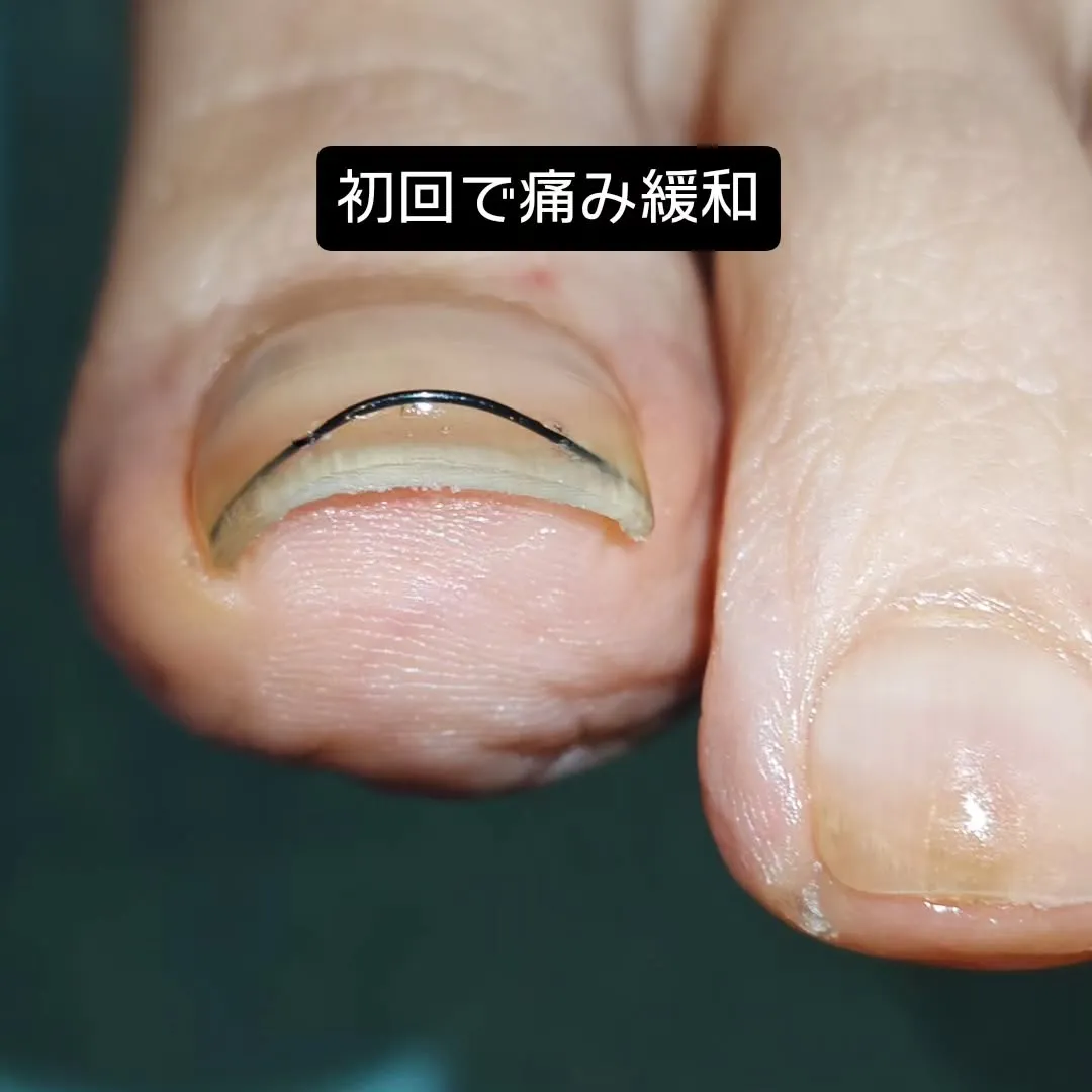 巻き爪が痛むとき、ついつい端っこを深く切ってしのいでいません...