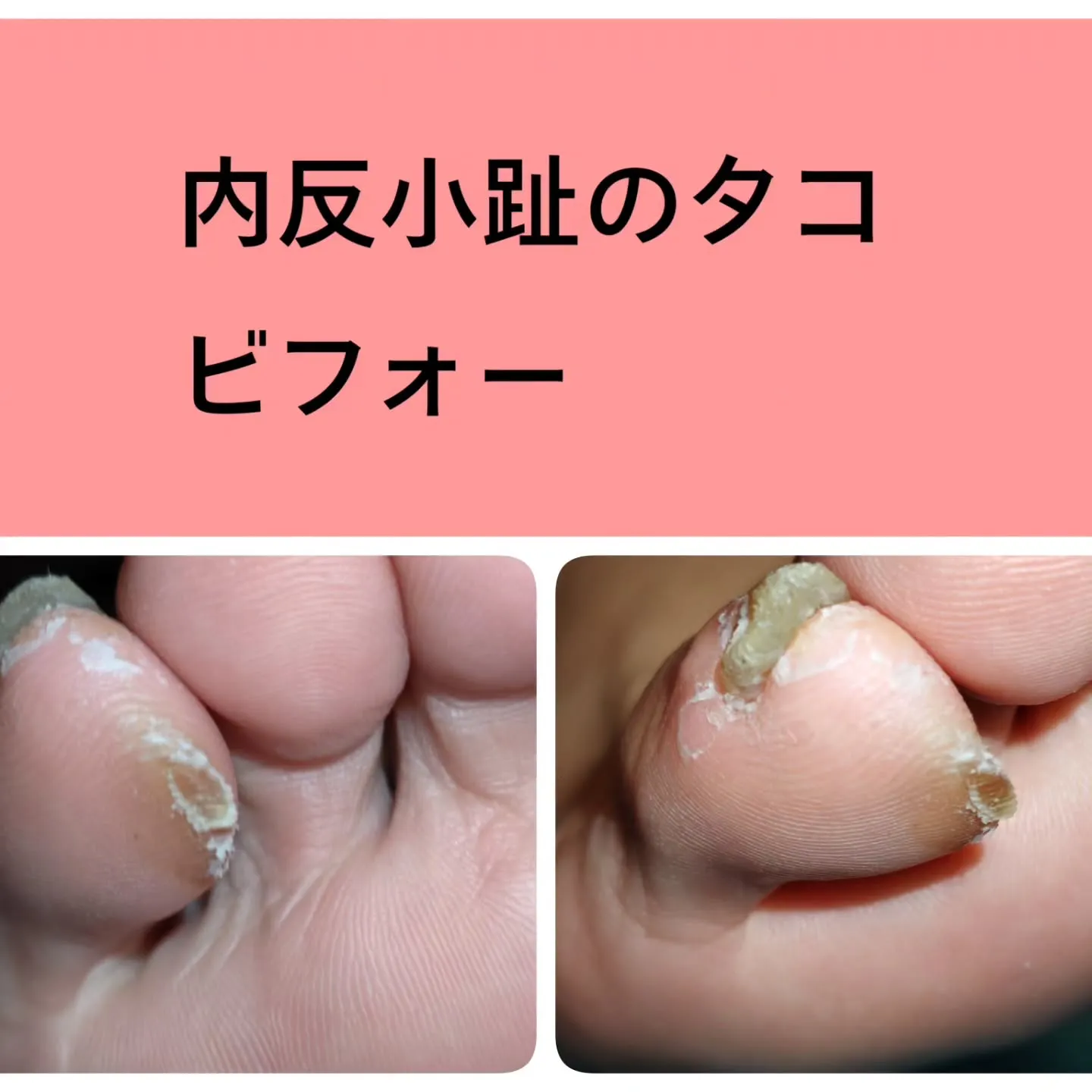 歩くたびに激痛…!小指のタコ、放置していませんか?⚡️