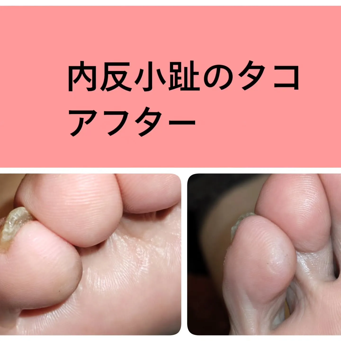 歩くたびに激痛…!小指のタコ、放置していませんか?⚡️