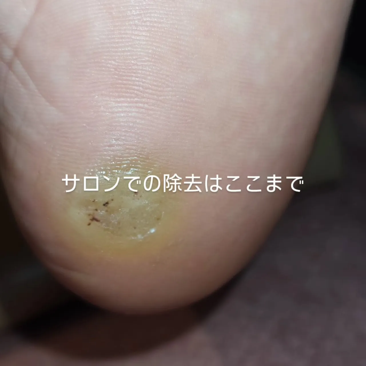 【そのイボ、放っておいてない?】放置するリスクとサロンでで...