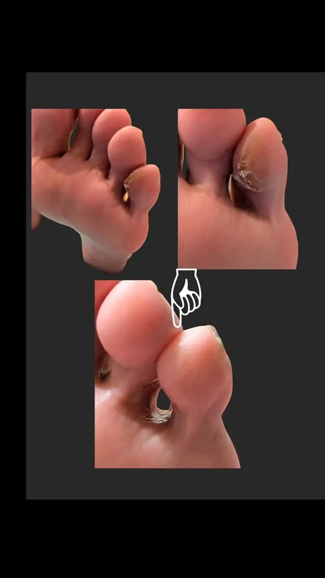 内反小趾は第5中足骨がくの字に内側に変形して起こります。